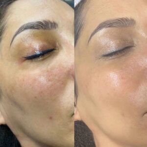 چطور لک پوستمو از بین ببرم؟