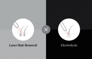 فرق الکترولیز با لیزر