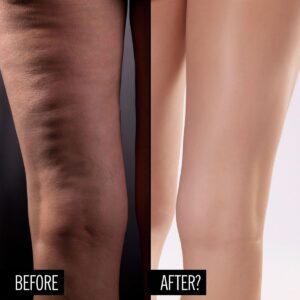 کربوکسی تراپی برای رفع سلولیت