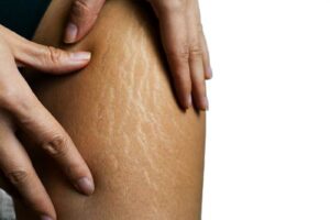 کربوکسی تراپی برای کاهش سلولیت: چگونه کمک می‌کند؟