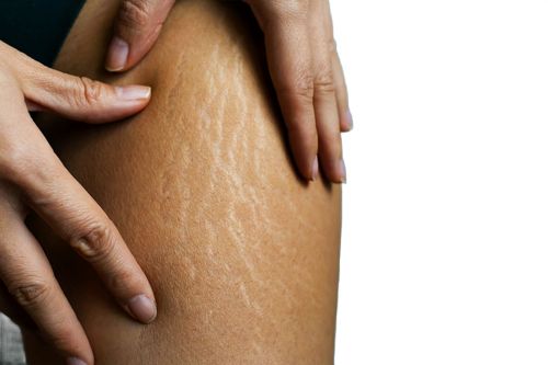 کربوکسی تراپی برای کاهش سلولیت: چگونه کمک می‌کند؟
