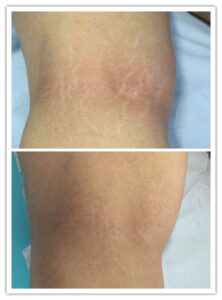 کربوکسی تراپی برای کاهش سلولیت پا