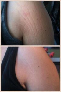 برای کاهش سلولیت چه کنیم؟