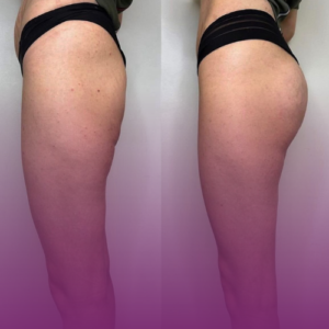 تزریق فیلر باسن در کرج