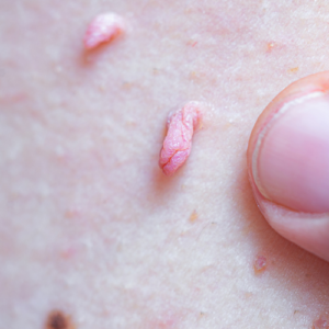 کرایوتراپی زگیل تناسلی در کرج