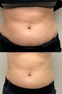 نتیجه دستگاه لاغری