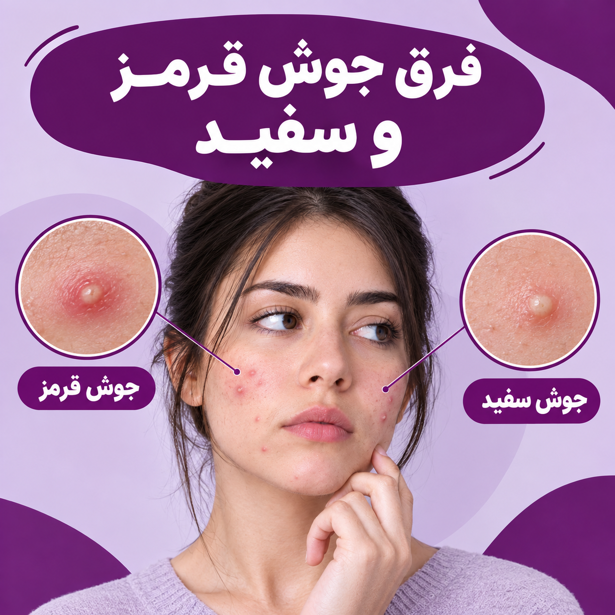 فرق جوش قرمز و سفید